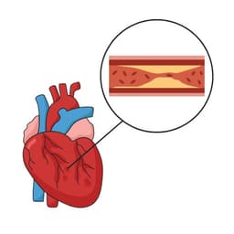 Coronary Artery Disease